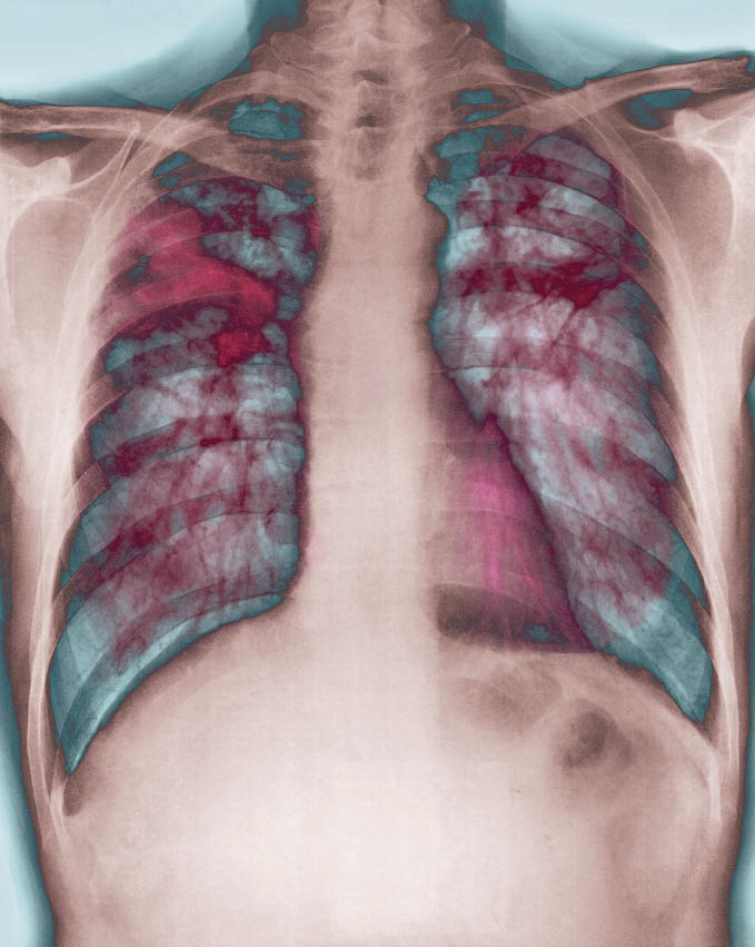 Bij longfibrose groeit fibreus littekenweefsel (donkerrood op de foto) tussen de alveoli. beeld: ANP