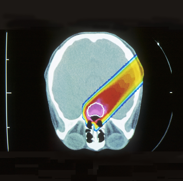Een compositie van meerdere CT-scans: de gele lijn is een protonstraal, gericht op een tumor in de hersenen. © Corbis