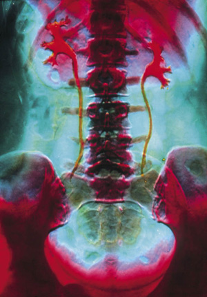 Röntgenopname met contrastvloeistof van nieren en blaas. Beeld: ANP Photo