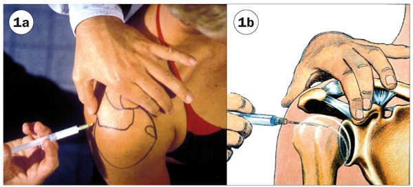  Figuur 1a en 1b. Plaatsing van de naald bij het geven van een injectie in het glenohumerale gewricht. De naald wordt opgevoerd tot hij het kraakbeen van de humeruskop raakt.