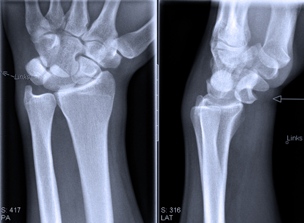 De röntgenfoto’s laten een volaire perilunaire luxatie zien.